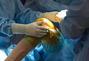 Read more about the article Total Knee Replacement Surgery: Top Myths & Facts